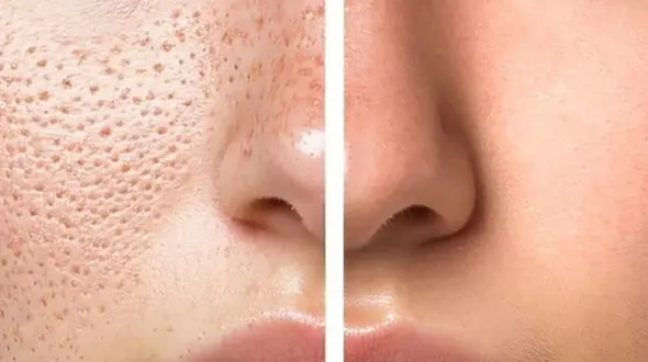 پاکسازی و درمان منافذ باز بینی به روش های طبیعی و کاربردی