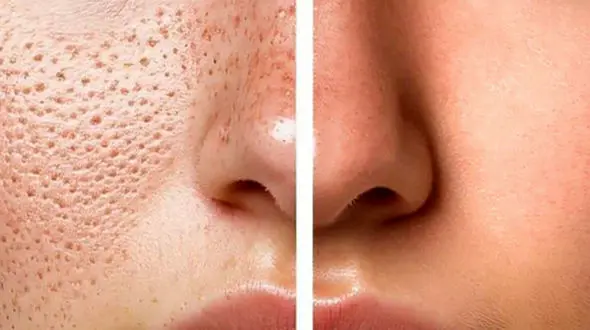 پاکسازی و درمان منافذ باز بینی به روش های طبیعی و کاربردی