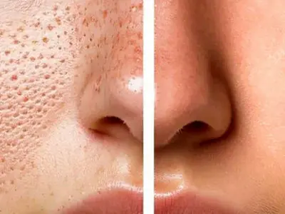 پاکسازی و درمان منافذ باز بینی به روش های طبیعی و کاربردی