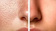 پاکسازی و درمان منافذ باز بینی به روش های طبیعی و کاربردی