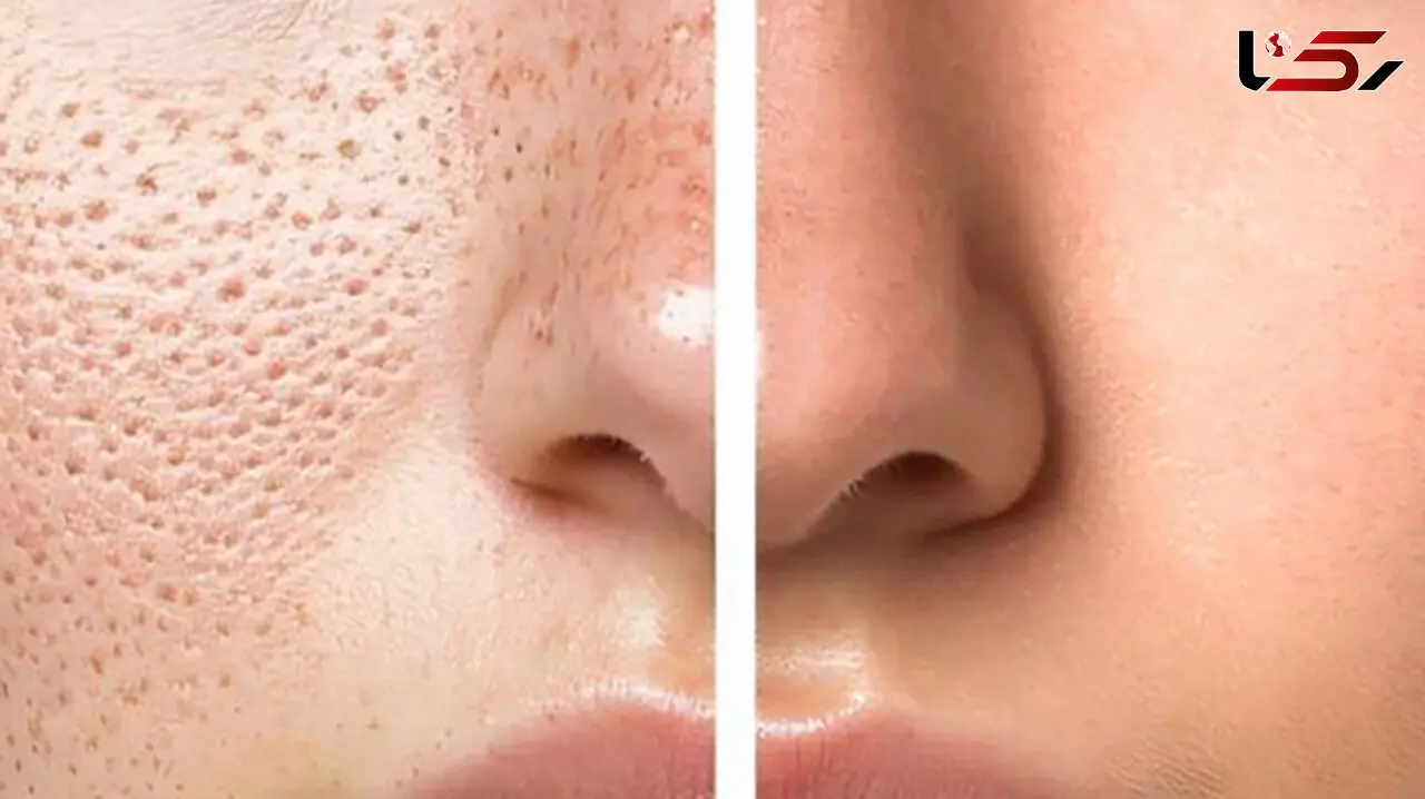 پاکسازی و درمان منافذ باز بینی به روش های طبیعی و کاربردی