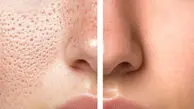پاکسازی و درمان منافذ باز بینی به روش های طبیعی و کاربردی