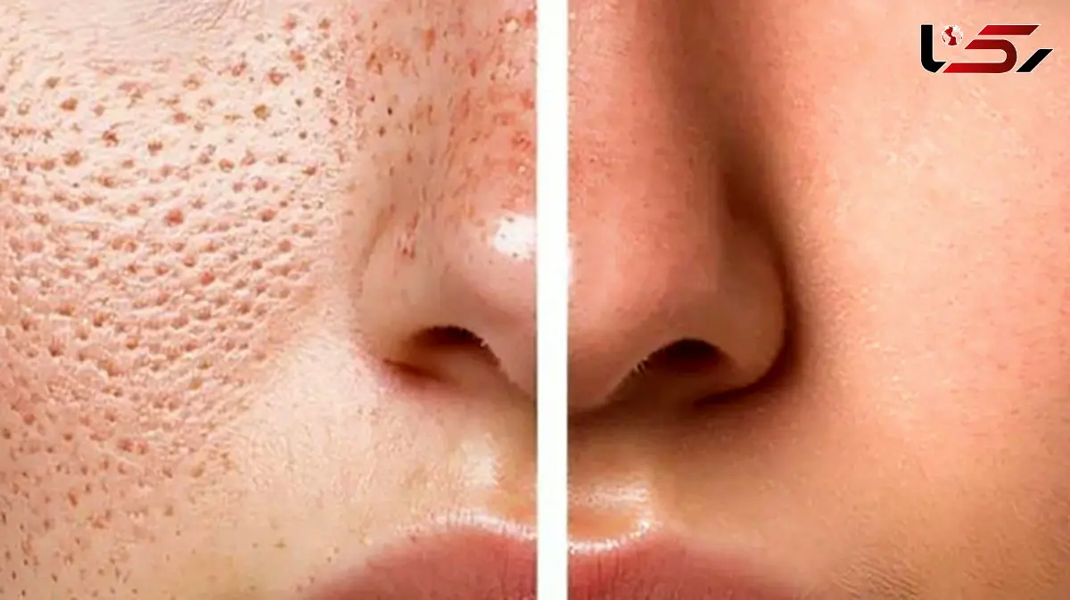 پاکسازی و درمان منافذ باز بینی به روش های طبیعی و کاربردی