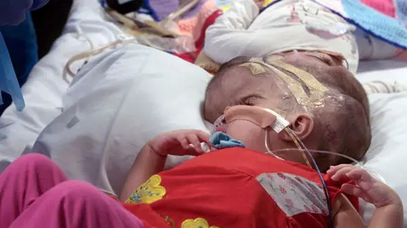 جراحی 50 ساعته دوقلوهای بهم چسبیده+عکس