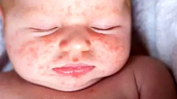 همه چیز درباره بیماری مخملک/ نشانه های ابتلا به آن چیست؟