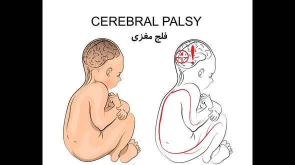 فلج مغزی چیست؟