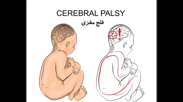 فلج مغزی چیست؟