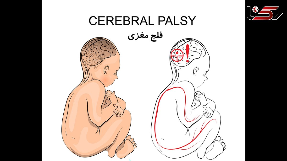 فلج مغزی چیست؟