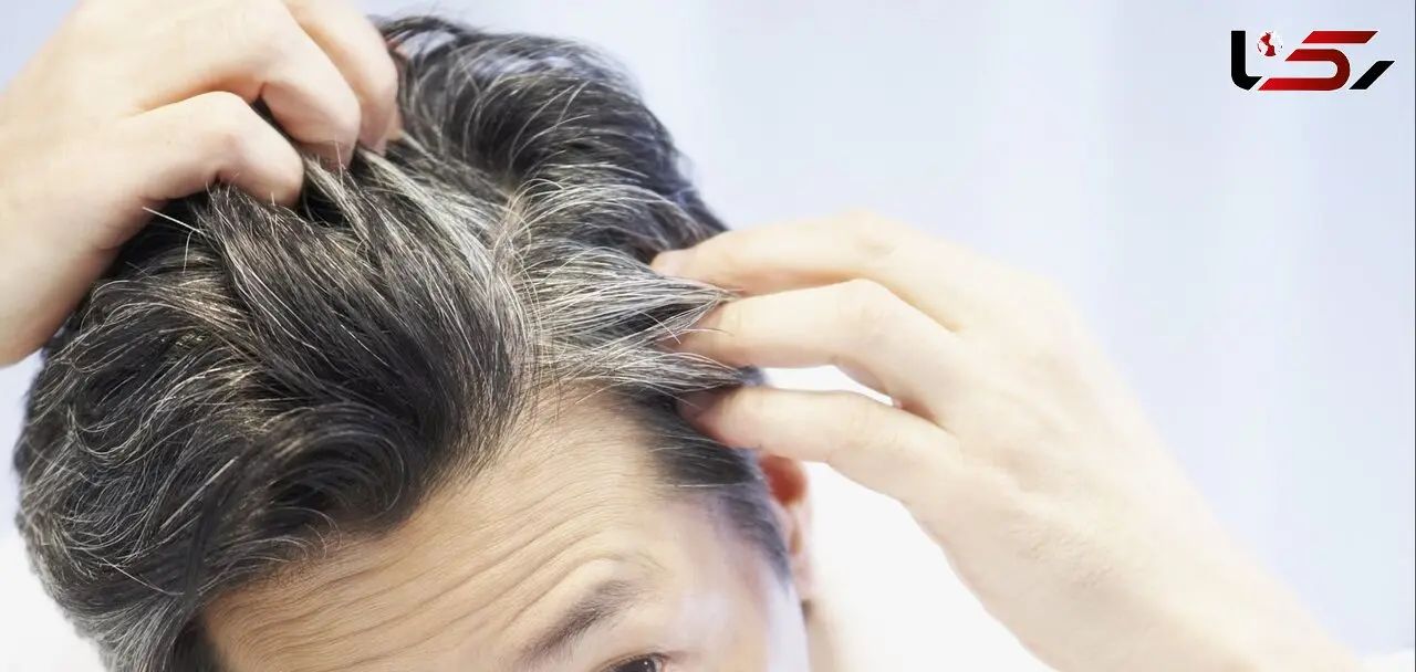 چرا موها در سن پایین سفید می شوند