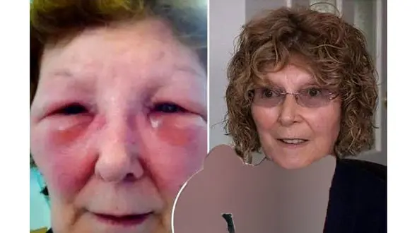 صورت زن بیچاره بعد از تزریق بوتاکس داغون شد ! +عکس