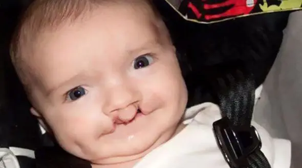 این پسر بچه باصورت گربه ای شکل به دنیا آمد + عکس 