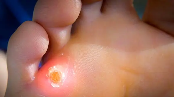 وازلین درمان کننده میخچه پا