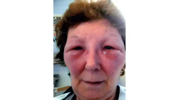 بوتاکس چهره یک زن را وحشتناک کرد / دکتر محاکمه می شود + عکس قبل و بعد زن