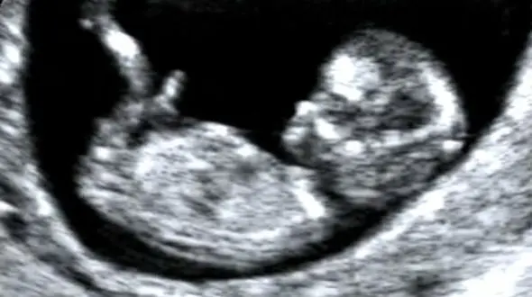 خطرات سونوگرافی در دوران بارداری