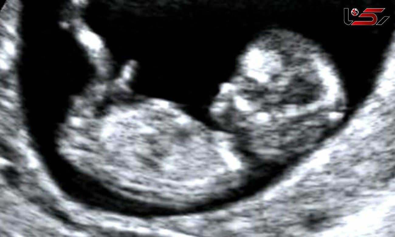خطرات سونوگرافی در دوران بارداری