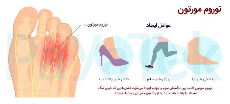 تیر کشیدن انگشتان پا