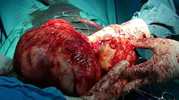 توده ای  4 کیلویی از شکم یک بیمار  