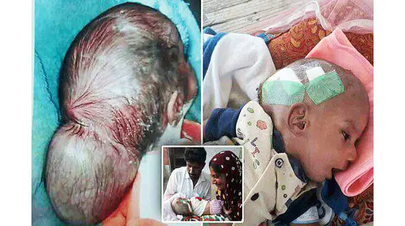  تخلیه غده‌ای به اندازه توپ بیسبال از سر پسربچه+عکس