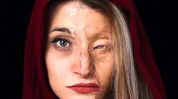 زیبایی جادویی دختر اسیدسوخته در لباس عروس ! + عکس داماد عاشق پیشه 