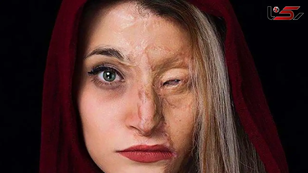 زیبایی جادویی دختر اسیدسوخته در لباس عروس ! + عکس داماد عاشق پیشه 