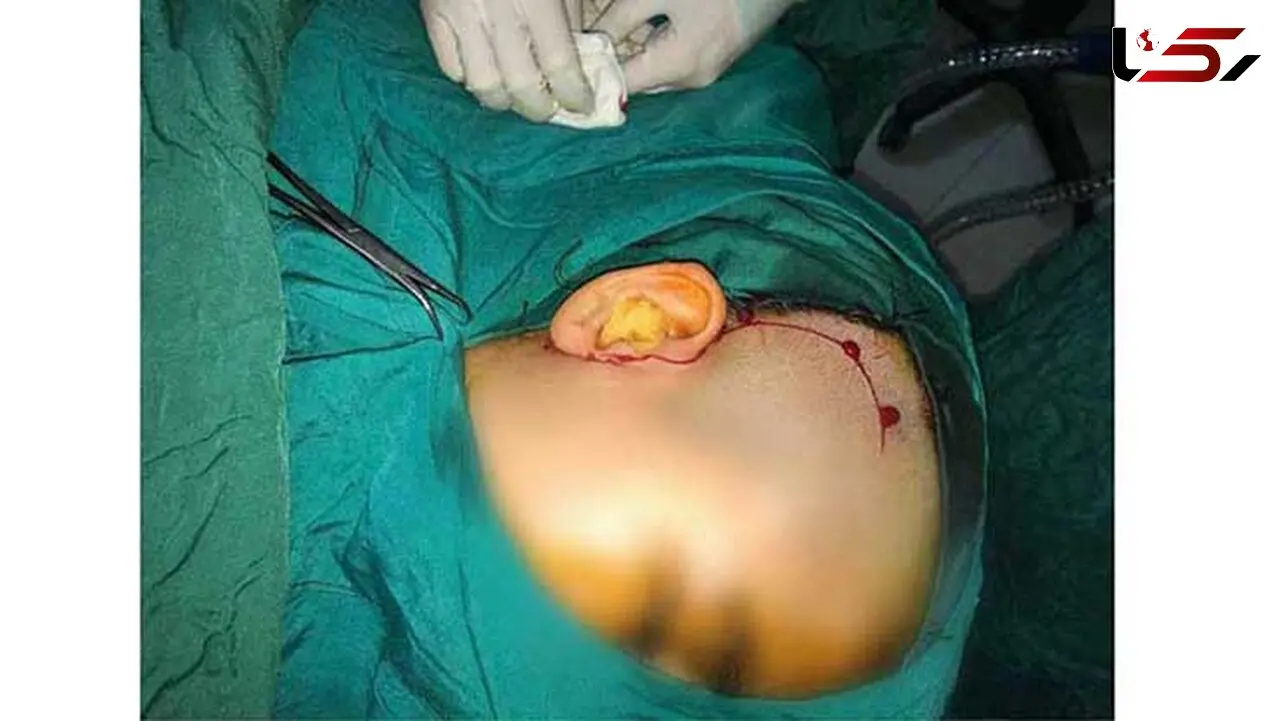خطای پزشکی جراح پاکستانی توسط متخصصان زاهدانی برطرف شد 