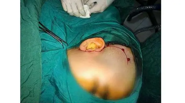 خطای پزشکی جراح پاکستانی توسط متخصصان زاهدانی برطرف شد 