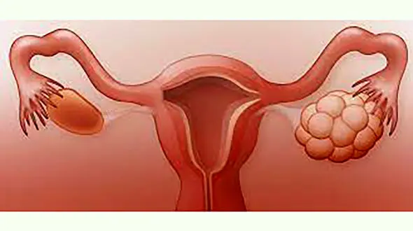 موهای زاید زنان نشانه چه بیماری هایی است؟