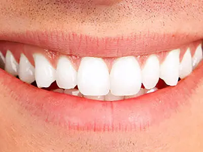 نشانه‌ های کاهش بهداشت دهان و دندان‌ / امیدواری به زندگی با سلامت دهان