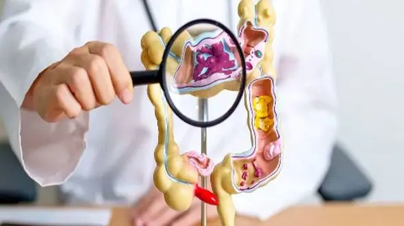 آزمایشی نوین برای پایان دادن به کابوس کولونوسکوپی