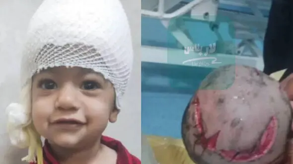 گرگ سر یک کودک لارستانی را گاز گرفت و پوست سرش را کند ! + عکس های دلخراش