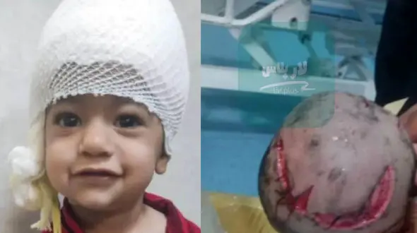 گرگ سر یک کودک لارستانی را گاز گرفت و پوست سرش را کند ! + عکس های دلخراش