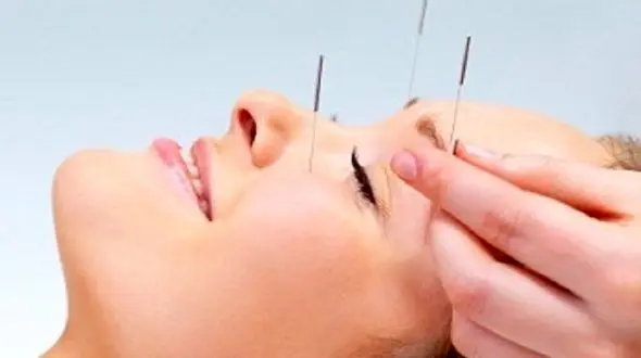 آیا طب سوزنی در درمان جوش جوانی موثر است؟