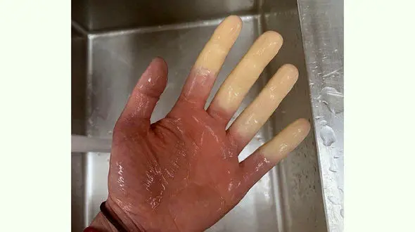 عجیب ترین سندروم را بشناسید