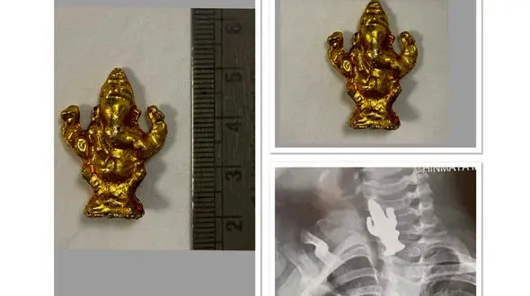 این شی فلزی در گلوی کودک 3 ساله گیر کرد / در یک قدمی مرگ بود