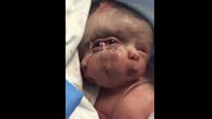 تولد نوزاد هندی با 3 صورت و 3 چشم..!! + فیلم حیرت آور 