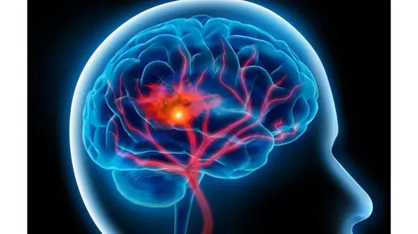 سکته مغزی دومین علت مرگ در ایران / سهم بالاتر مردان در بروز بیماری