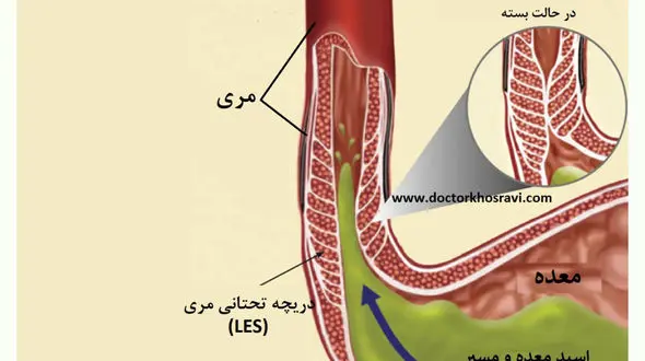 نشانه های مهم ریفلاکس معده به مری 