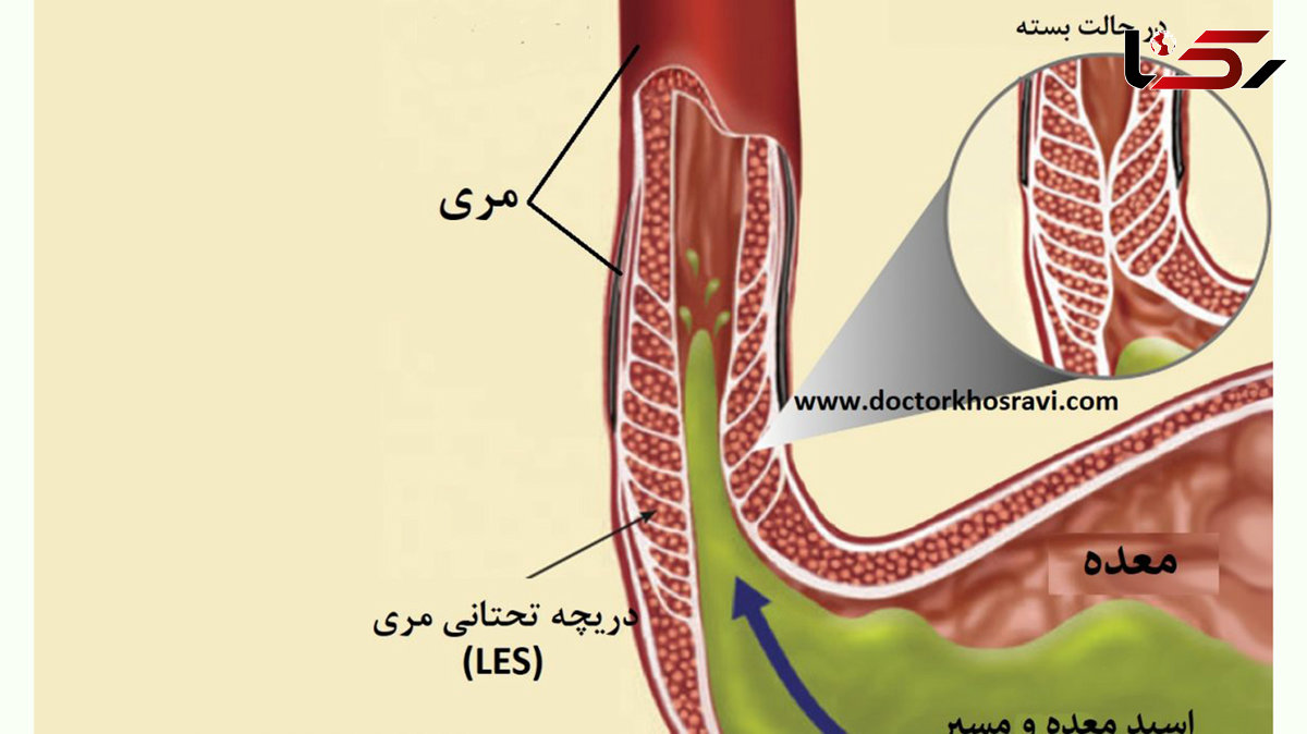 نشانه های مهم ریفلاکس معده به مری 