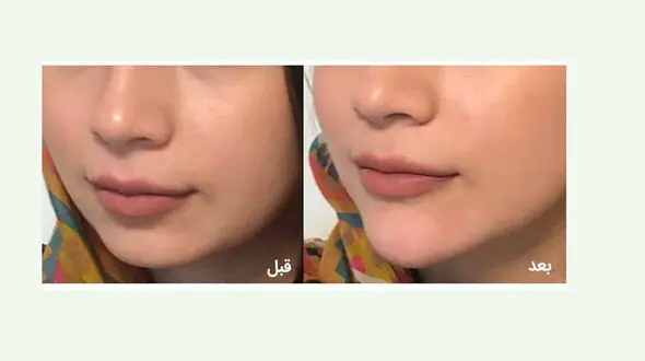 زاویه دار کردن چانه چگونه است؟