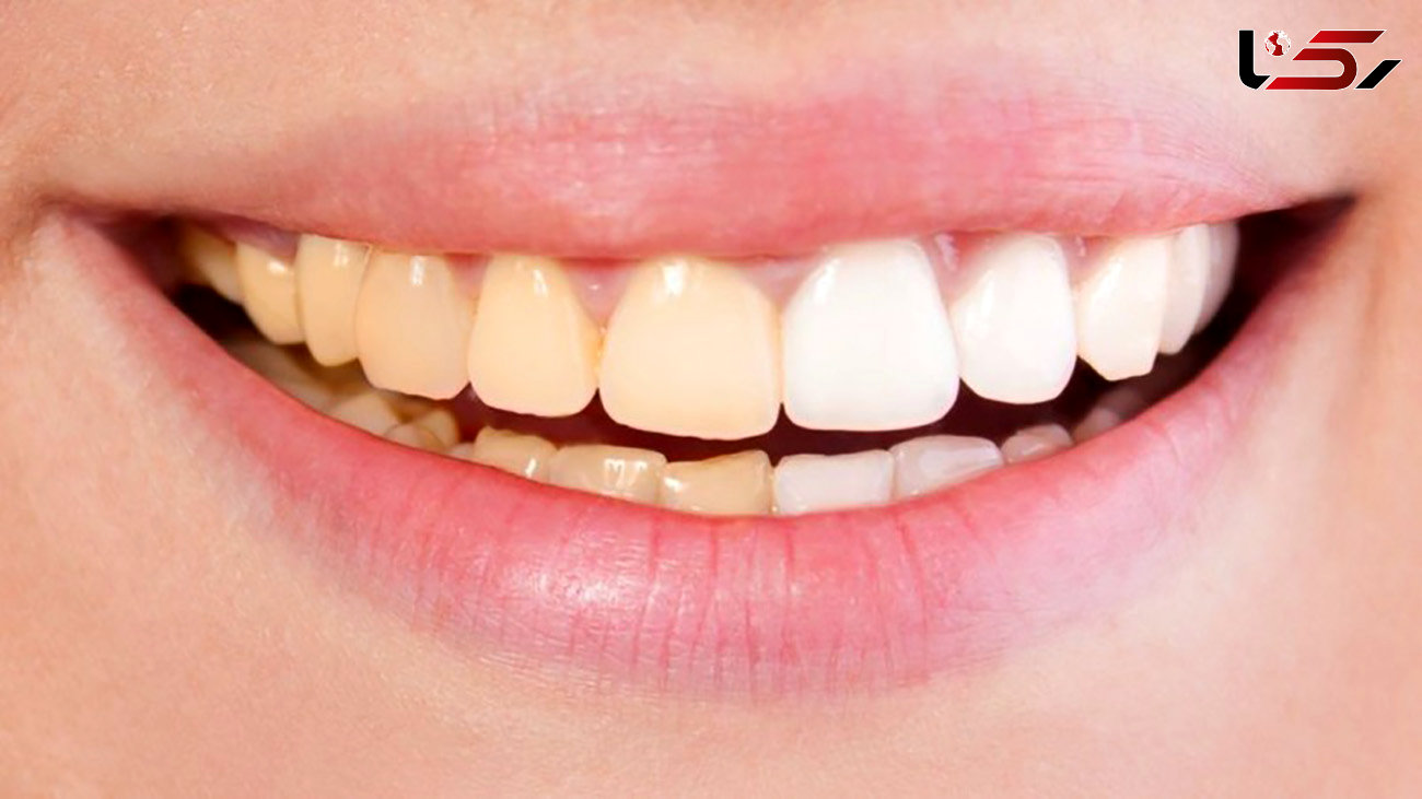 دلیل تغییر رنگ دندان چیست؟