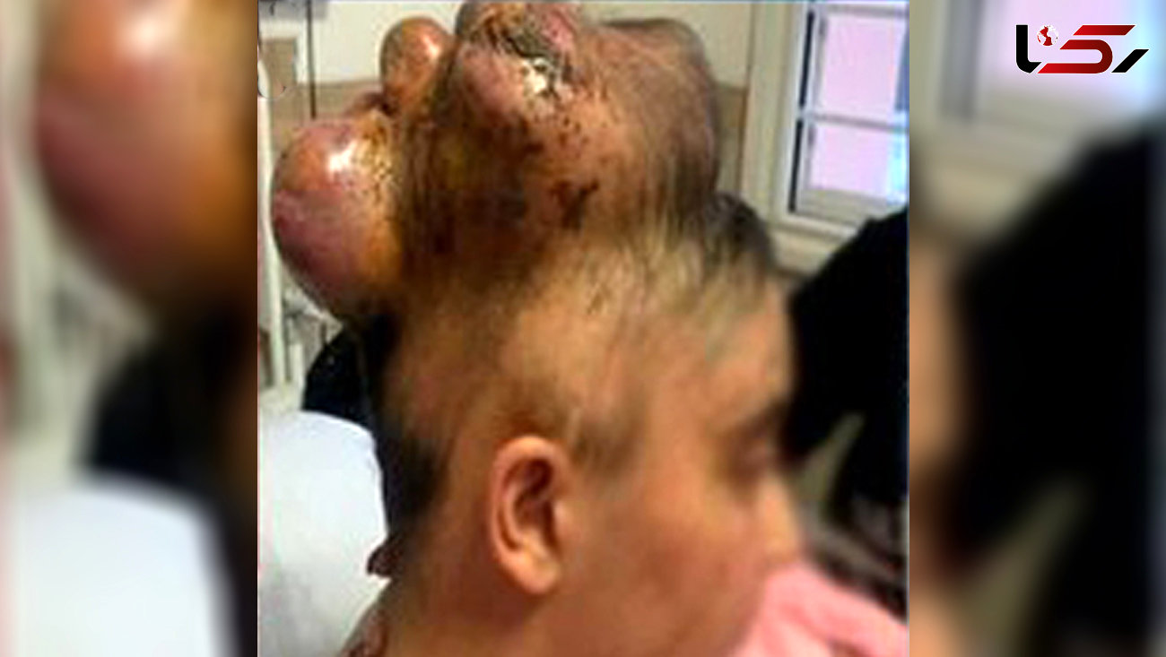 جراحی سر بزرگ ستایش 13 ساله / پیچیده ترین عمل جراحی جهان در یزد انجام شد + عکس