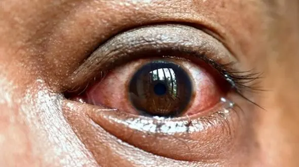 قارچ سیاه چیست؟