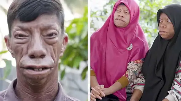 سندروم عجیبی «خانواده مارمولکی» را شکل داد! + عکس باورنکردنی