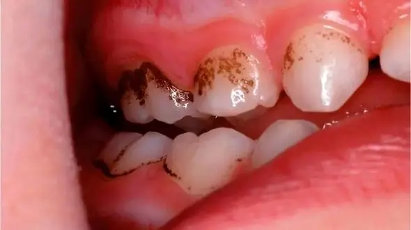 چرا باید مسواک و نخ دندان را جدی بگیرید؟