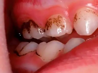 چرا باید مسواک و نخ دندان را جدی بگیرید؟