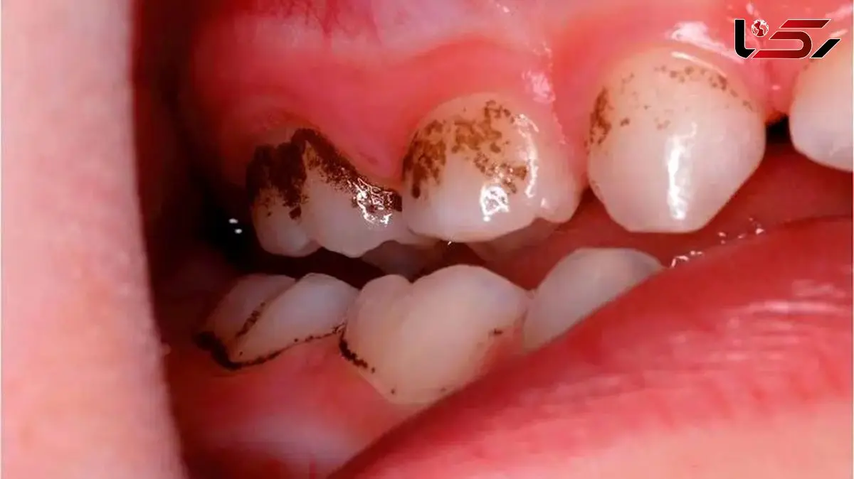 چرا باید مسواک و نخ دندان را جدی بگیرید؟