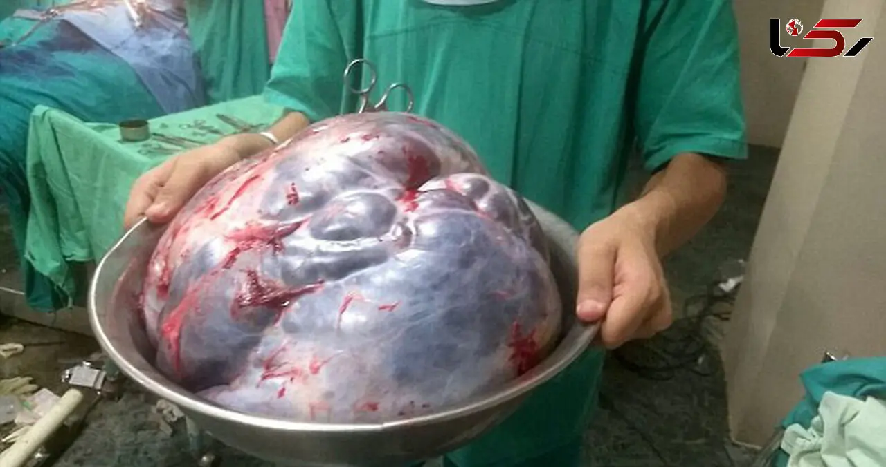 زنده ماندن زن 60 ساله بعد از عمل جراحی سخت+عکس
