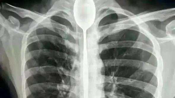 قورت دادن قاشق 20 سانتی سر شرط بندی / قاشق یکسال در گلویش بود + عکس