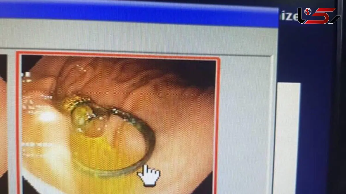 عکس عجیب از معده کودک 4 ساله بابلی