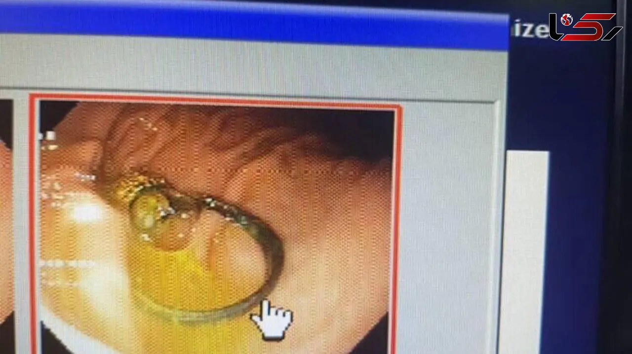 عکس عجیب از معده کودک 4 ساله بابلی